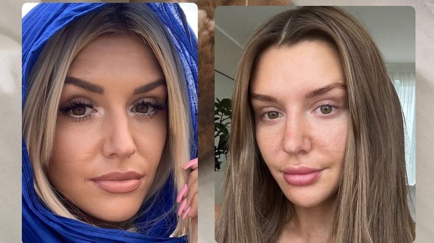 Gerda Lewis Botox Vergleich