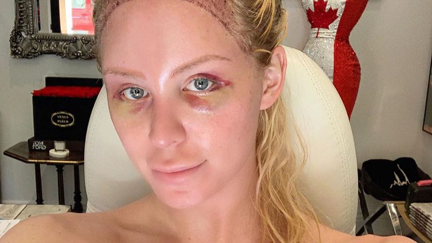 "Jahre der Scham": Gigi Gorgeous hatte Haar-Transplantation