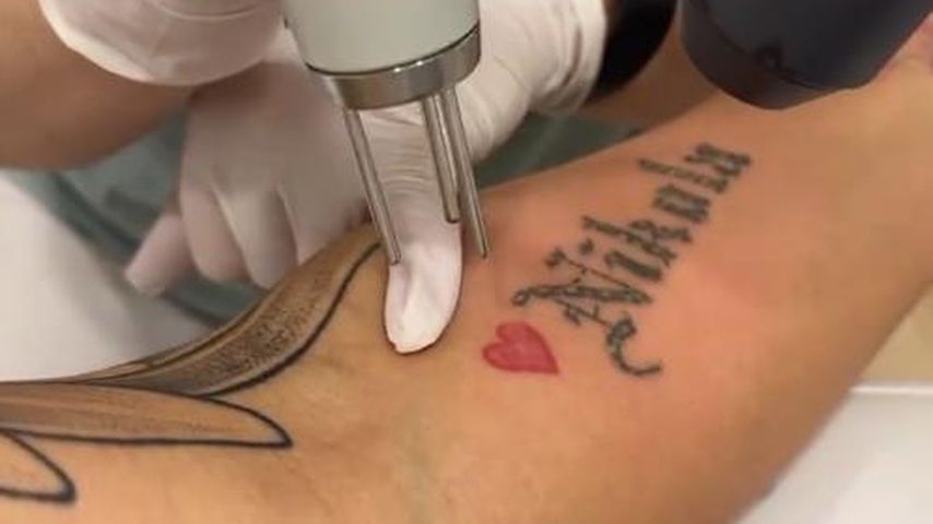 Gloria Glumac bei der Tattoo-Entfernung