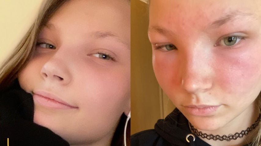 GNTM-Romy ohne und mit allergischer Reaktion im Gesicht