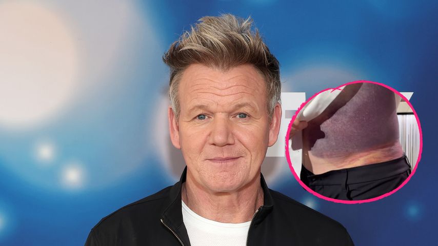 "Glück, hier zu sein": Gordon Ramsay hatte brutalen Unfall!