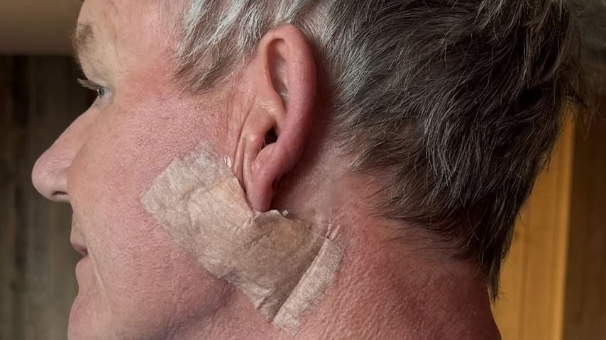 Gordon Ramsay zeigt sein Gesicht nach der Hautkrebs-Operation