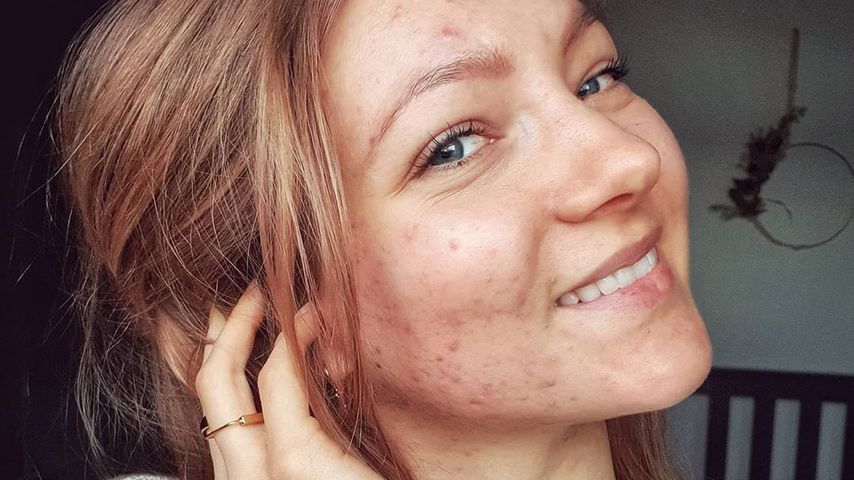 Anti-Akne-Kampf: Ex-GNTM-Hanna zeigt ungeschöntes Update