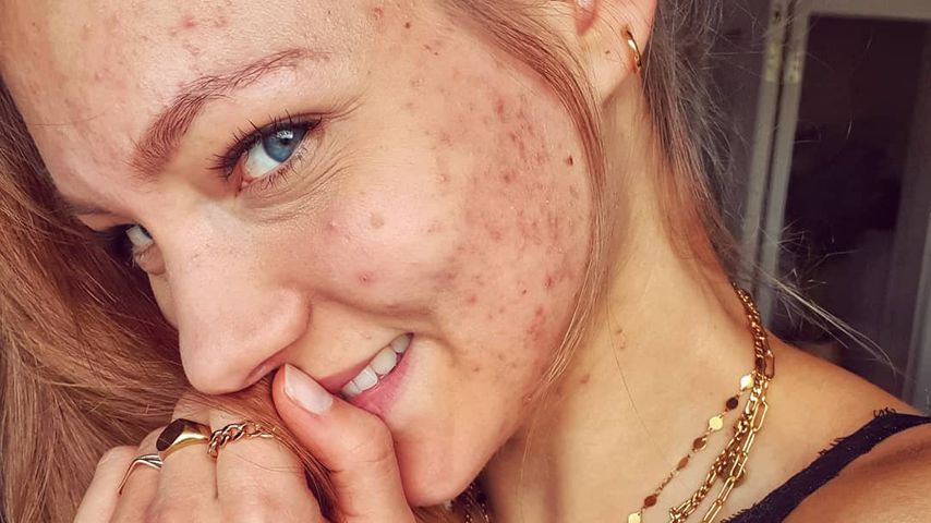 Pille abgesetzt: Ex-GNTM-Hanna kämpft immer noch gegen Akne!