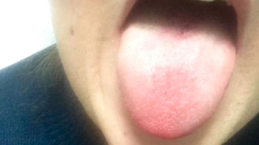 Helena Fürst nach einem allergischen Schok