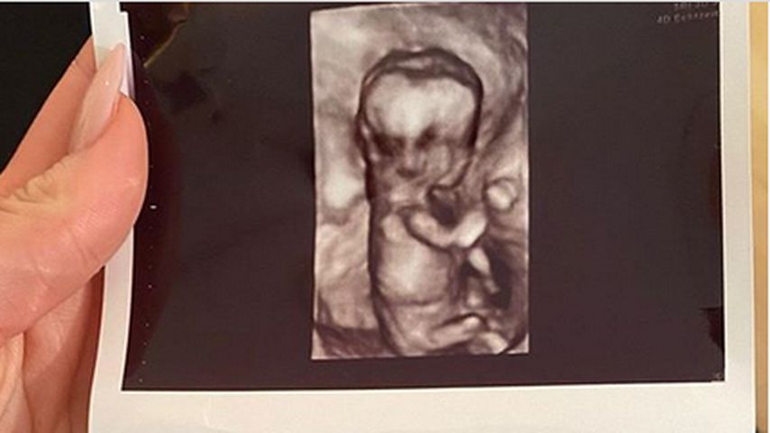 Ina Aogos Ultraschallbilder