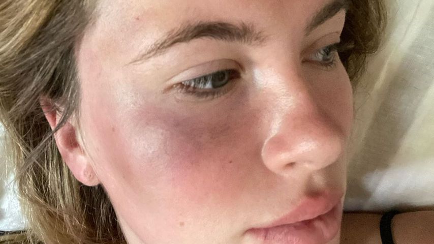 Heftige Fotos: Ireland Baldwin wurde überfallen und verletzt