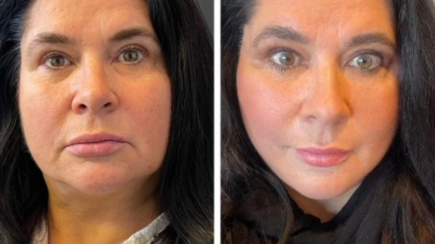 Mega-Facelift: Katzenmama Iris Klein zeigt ihr neues Gesicht