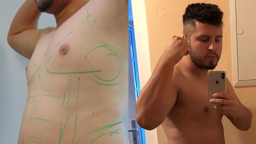 DSDS-Star Isa Martíno: Er ließ sich 3,4 Liter Fett absaugen!