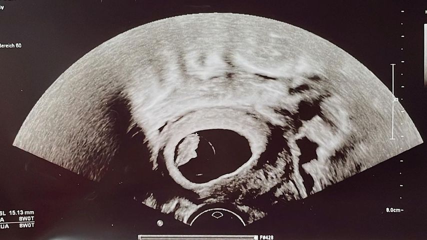 Ultraschallbild von Jan Leyks Nachwuchs, 2023