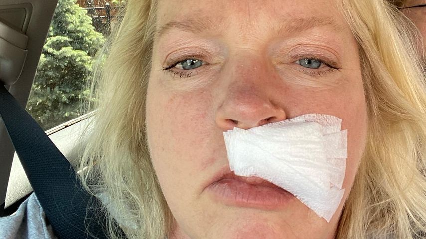 Janelle Brown nach ihrem Hautkrebs-Eingriff, 2021