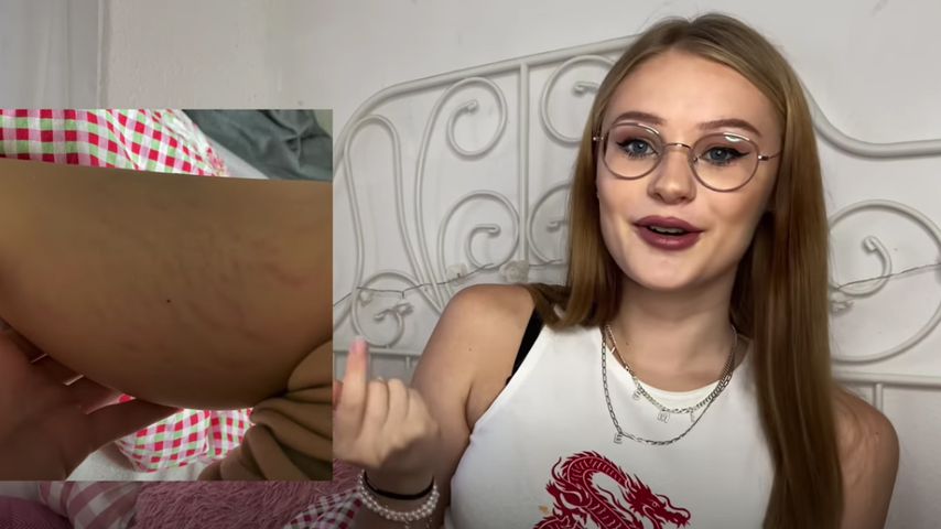 Jasi_xx3s Dehnungsstreifen an den Waden