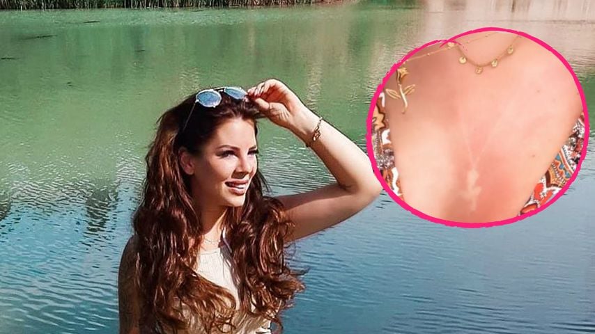 Autsch! Jenny Frankhauser hat üblen Dekolleté-Sonnenbrand