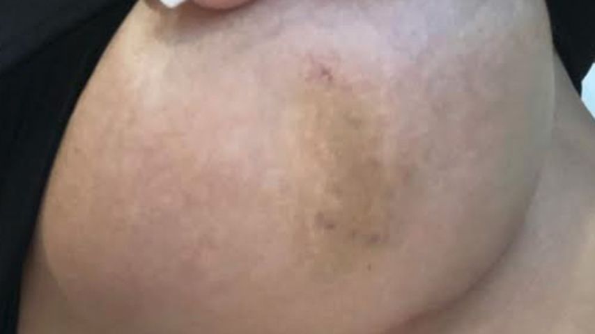 Jennifer Frankhauser zeigt ihre Verletzungen