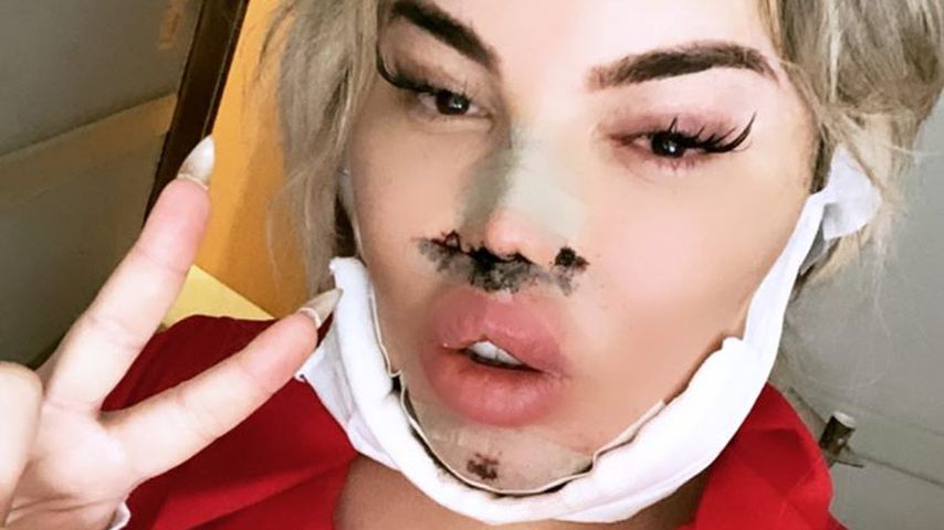 Beauty-Filler ausgelaufen: Jessica Alves zeigt Loch im Kinn
