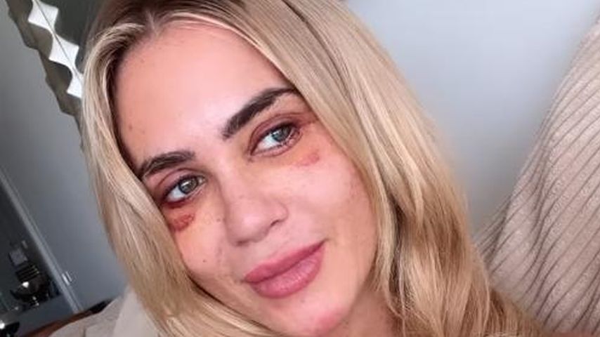 Fettgnubbel hinterm Auge: Jessica Haller verrät neue Details