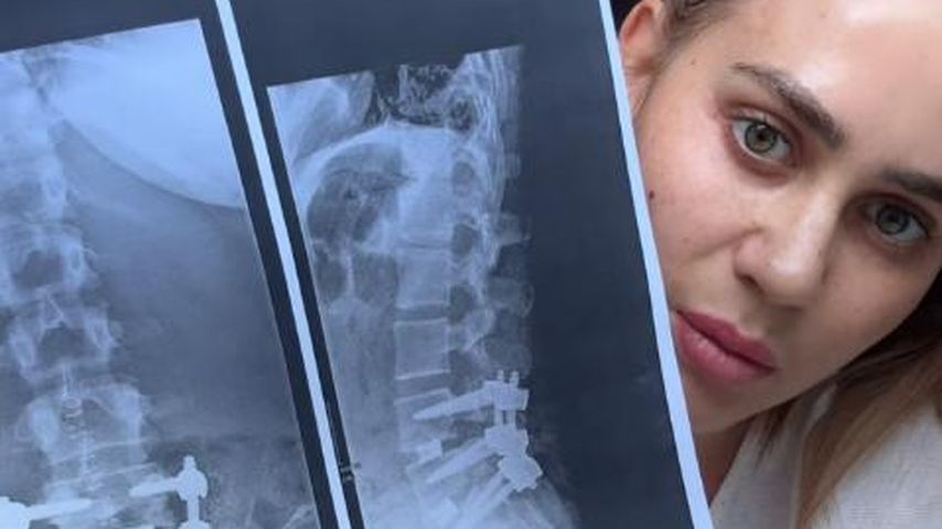 Jessica Hallers Wirbelsäule nach der Operation