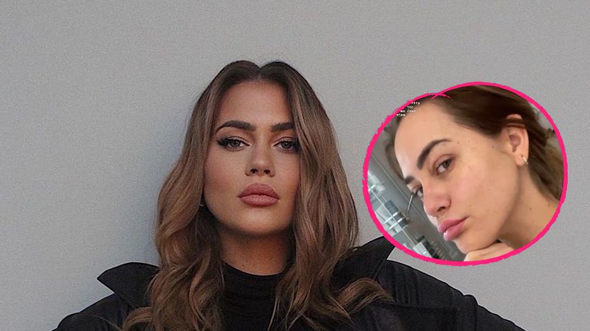 Hyperpigmentierung: Jessica Paszka zeigt sich ohne Filter!