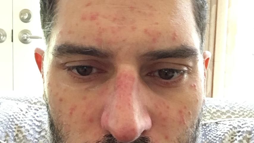 Joe Manganiello zeigt die Auswirkung seiner Krankheit auf sein Hautbild