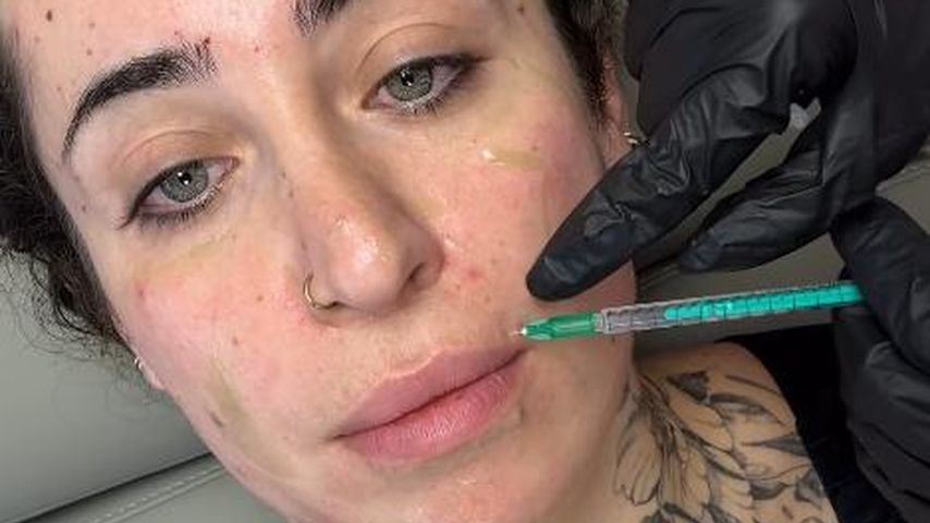 Nach Implantentfernung: Jolina Mennen lässt Lippen auflösen
