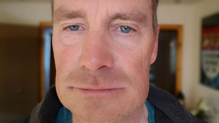 Nach Tumor-Entfernung: Jürgen Milskis Gesicht angeschwollen!