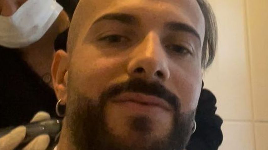 Julian Evangelos vor seiner Haartransplantation