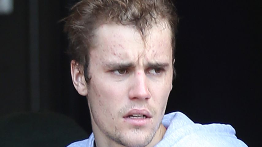 Pickel-Rückfall? Justin Bieber hat wieder schlechte Haut