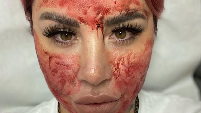 Kate Merlan nach dem Vampir-Lifting im Januar 2021