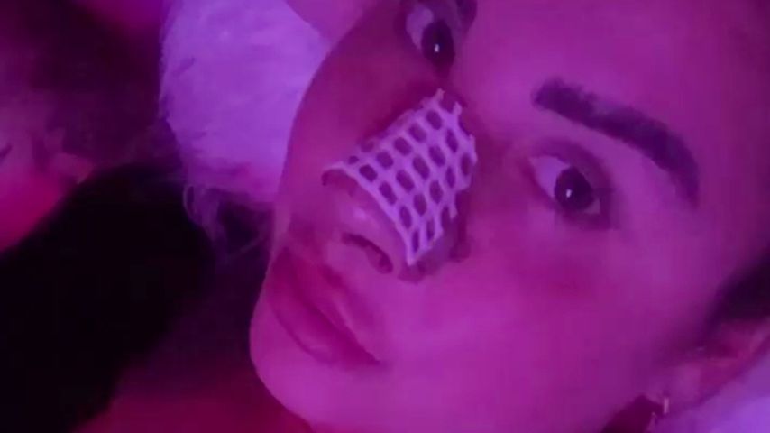 Kate Merlan nach ihrer Nasenoperation