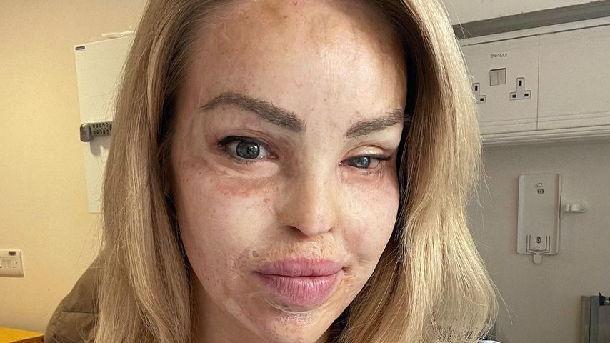 Not-OP an Speiseröhre: Säure-Opfer Katie Piper gibt Update