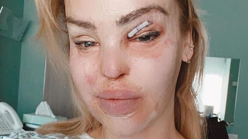 400. OP überstanden: Säure-Opfer Katie Piper gibt Update!