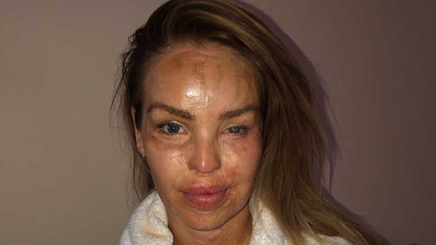 Verletzung durch Säure-Angriff: Katie Piper teilt Schock-Pic
