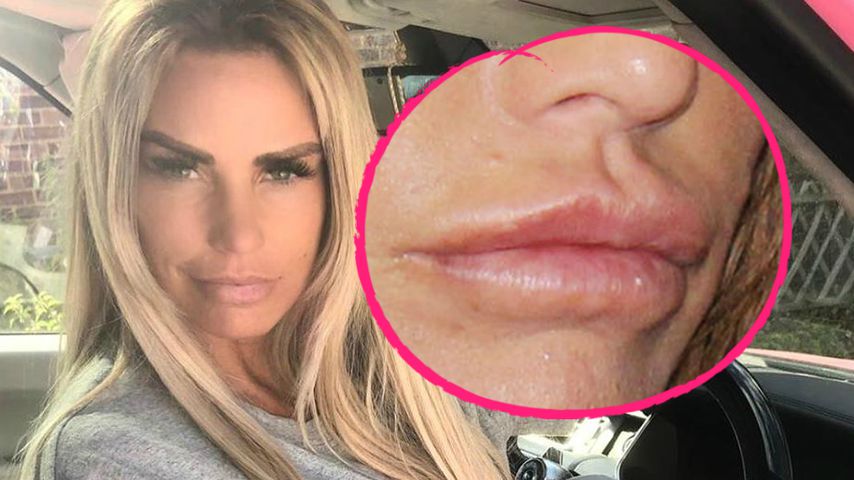 Dicke Botox-Lippen: War Katie Price erneut beim Beauty-Doc?