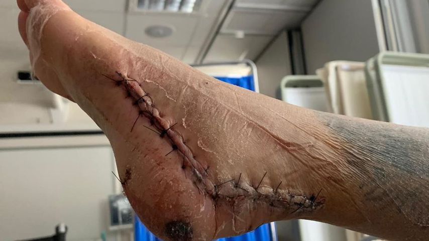 Katie Price' genähter Fuß