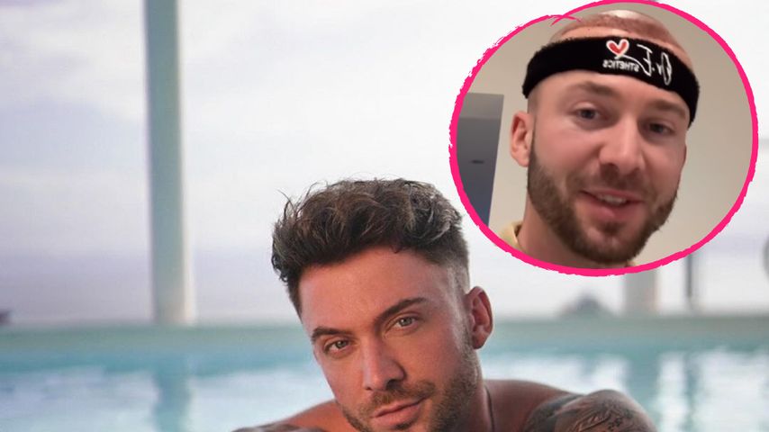 Keno Rüst ehrlich: Er hat sich Haare transplantieren lassen!