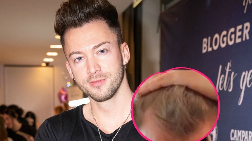 Bachelorette-Boy Keno Rüst lässt sich Haare transplantieren