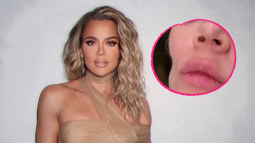 Khloé Kardashian zeigt krasse Beule nach ihrer Hautkrebs-OP