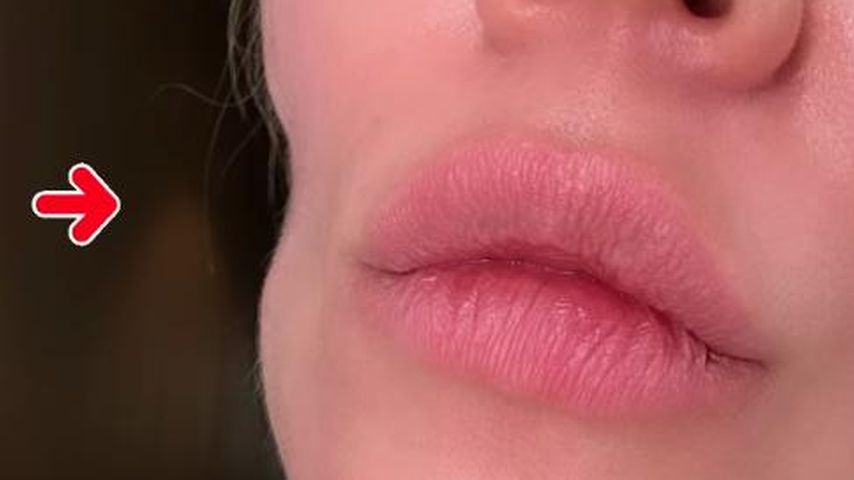 Khloé Kardashians Einbuchtung nach der OP