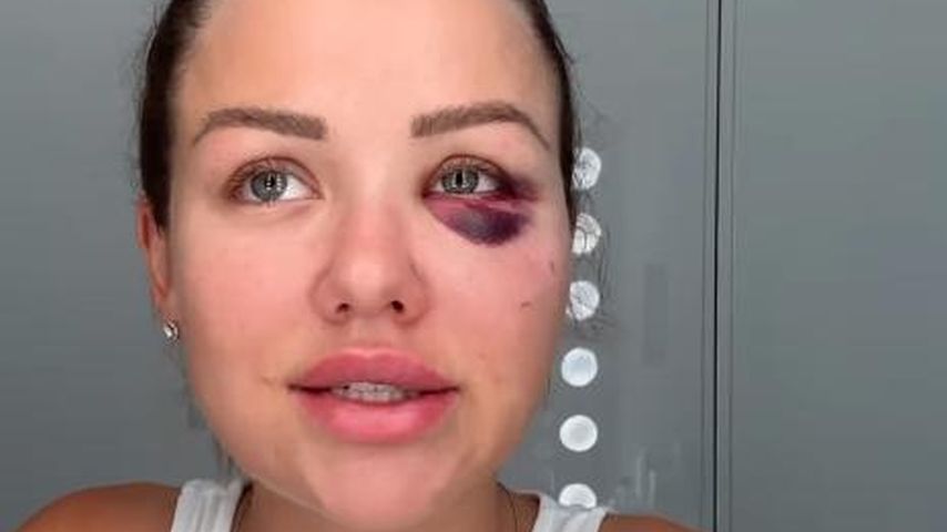 Kim Gloss fiel eine zehn Kilo schwere Hantel aufs Gesicht!