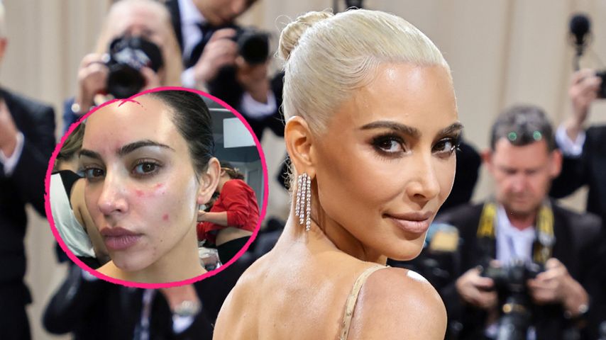 Schuppenflechte ruinierte fast Kim Kardashians Gala-Auftritt