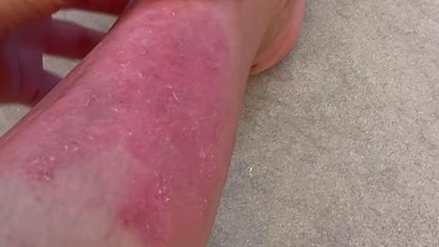 Kim Kardashians Psoriasis im Januar 2024