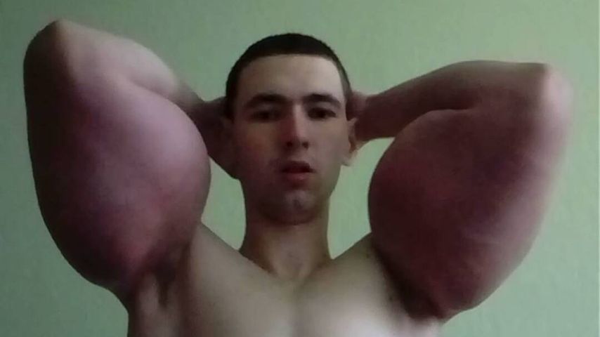 "Dummheit": TikTok-Popeye könnte wegen Bizeps-Filler sterben