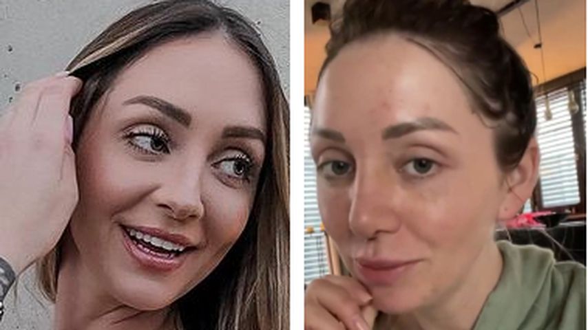 Kurz nach OP: Gerdas Ex-BFF Larissa zeigt ihre neue Nase