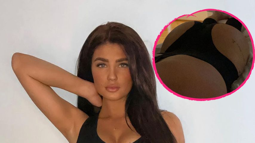 "Love Island"-Lauras Po-OP: 800 Milliliter Fett umverteilt