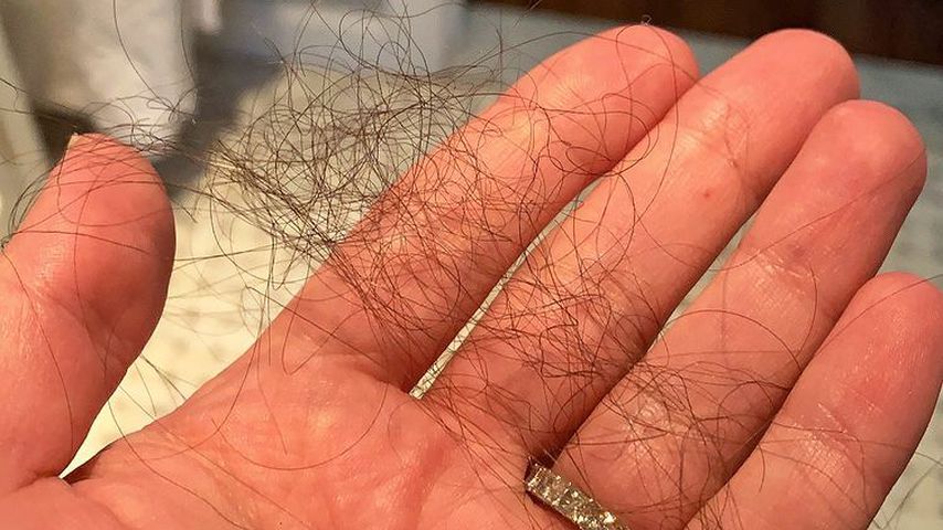 Lea Micheles ausgefallenen Haare