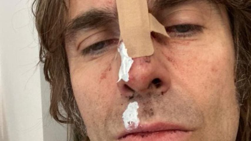 Ramponiertes Gesicht: Liam Gallagher aus Helikopter gestürzt