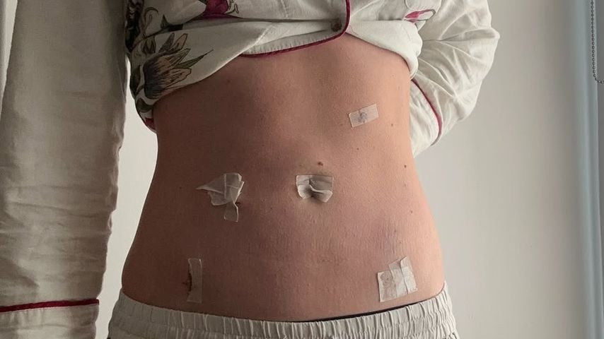 Lili Reinhart zeigt ihren Bauch nach der OP, 2025