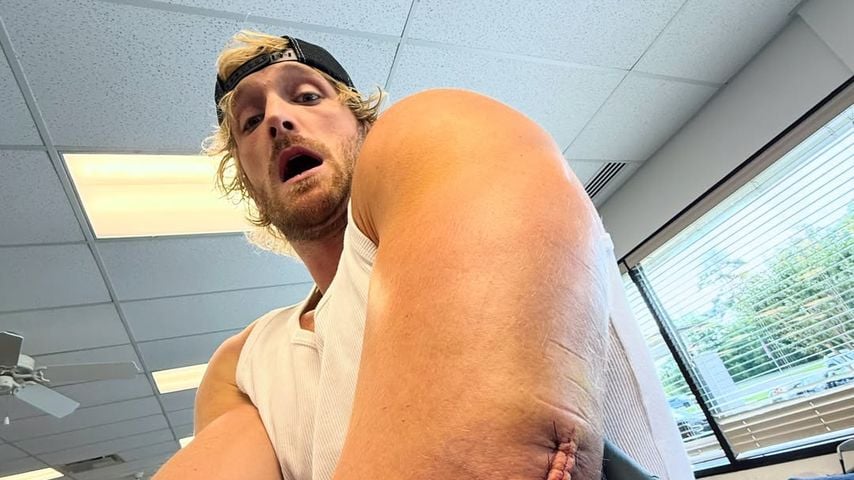 Logan Pauls XXL-Narbe nach dem Eingriff, Mai 2026