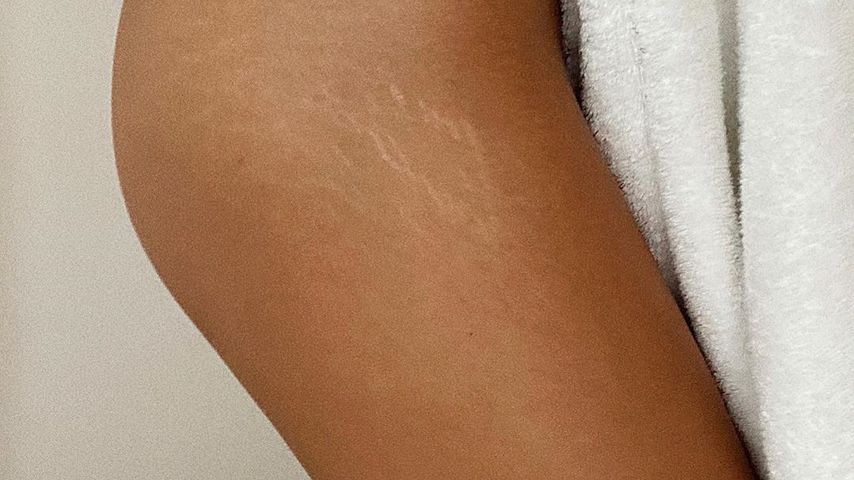 Model Lorena Rae zeigt ihre Dehnungsstreifen