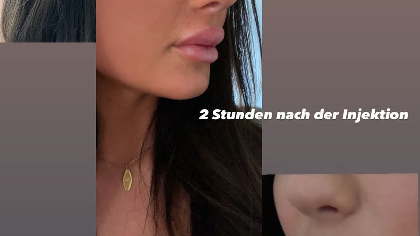 "Love Island"-Star Lauras Lippenveränderung